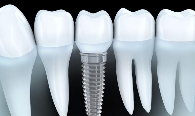 implantes-dentales