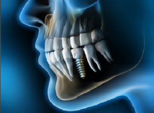 implantes1