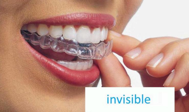 ortodoncia_invisible